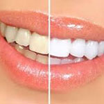 Alanya-Teeth-Whitening