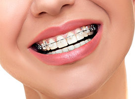 Alanya-ortodonti-tedavisi