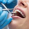 dental-implants-in-antalya