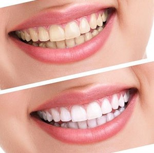 Alanya-Teeth-Whitening