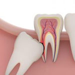 gömülü diş tedavisi