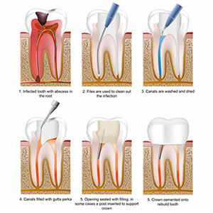 Alanya-Root-Canal-Treatment