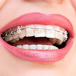 alanya ortodontik (diş teli) tedavileri